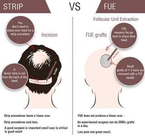 fue and fut compressed 300x284 - Benefits of FUE Hair Transplant