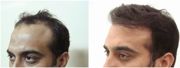 Our Before After Natural Results - All You Need to Know about Fixing Bad Hair Transplants