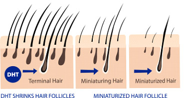 Causes of Male Hair Loss - Male Hair Loss