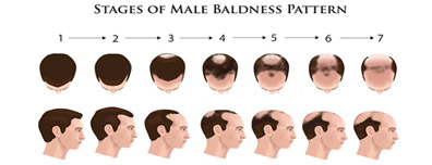 Male Pattern - Male Hair Loss