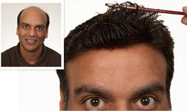 Results2 - Male Hair Loss