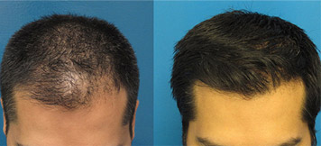prp Results1 - PRP Therapy for Hair Loss