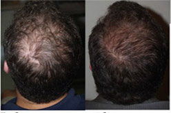 prp Results2 - PRP Therapy for Hair Loss
