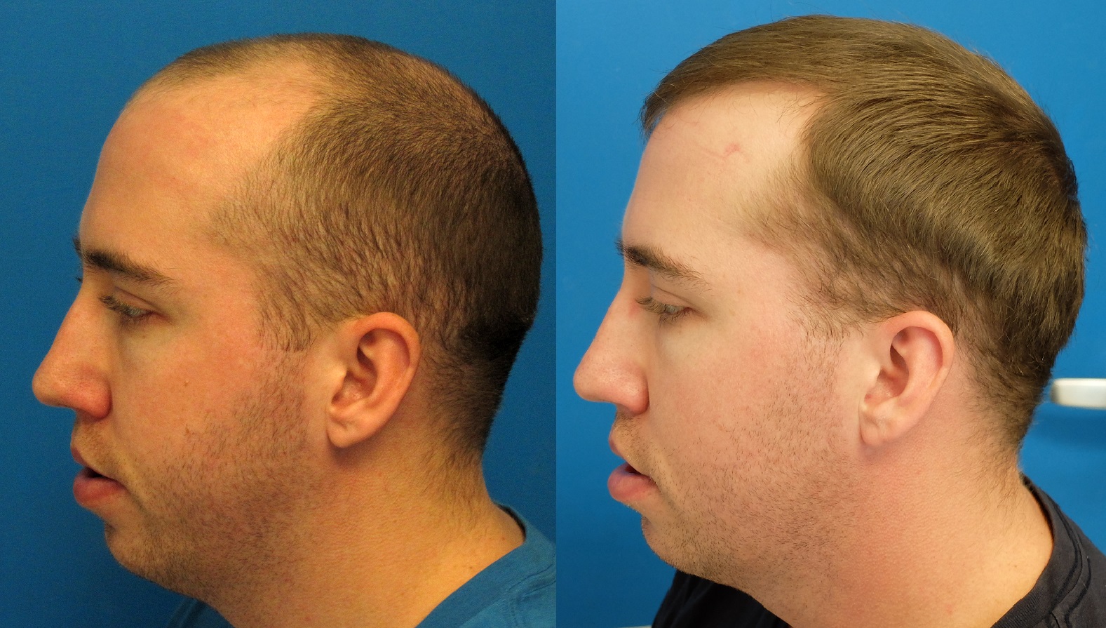 What are the Advantages Of Hair Transplantation Surgery?