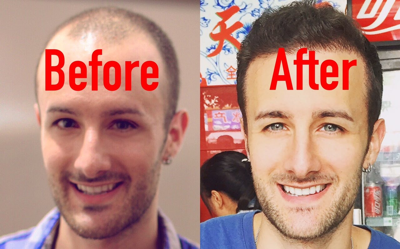 Hair Transplant in Chandigarh 4 - What Is The Cost Of A Hair Transplant Surgery?