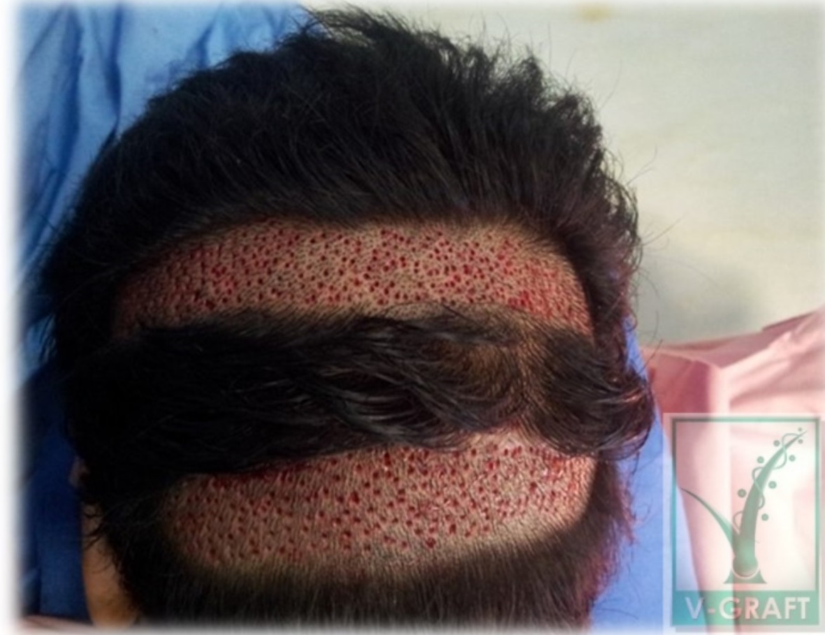 Hair Transplant in Chandigarh 6 - Why Go For Best Hair Loss Treatment In Chandigarh?