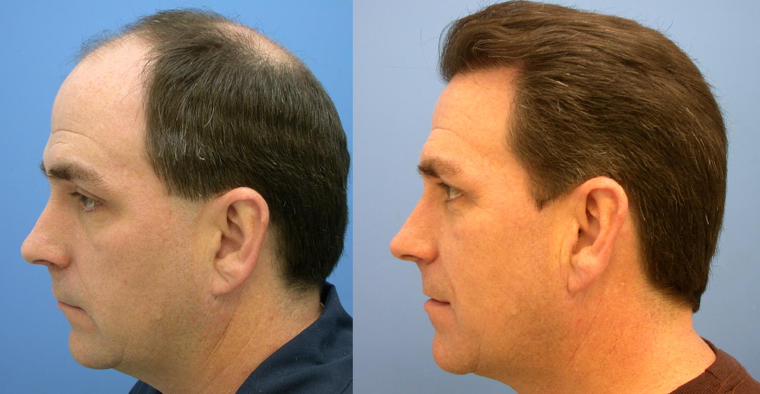 Hair Transplant in Chandigarh 9 - Why Do Women Suffer From Hair Loss Problem?