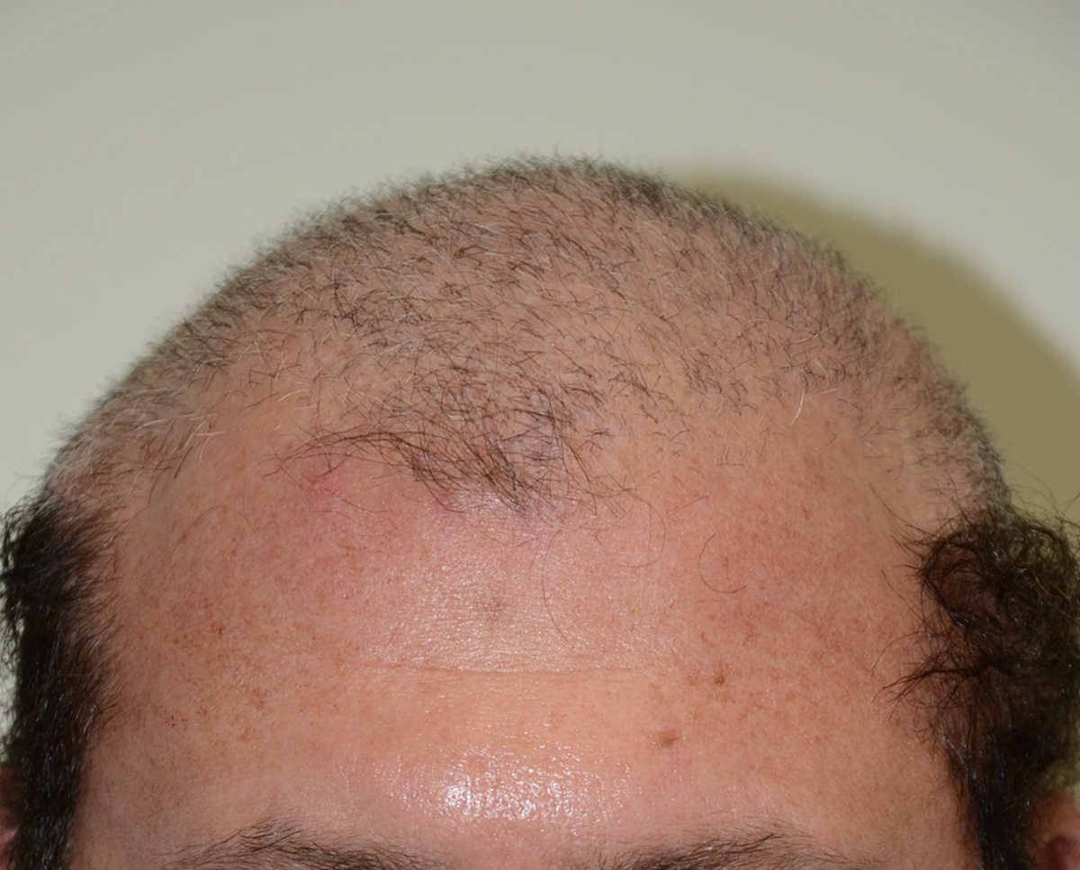 Hair Transplants Chandigarh 13 - Avoid Baldness In Simplest Possible Way