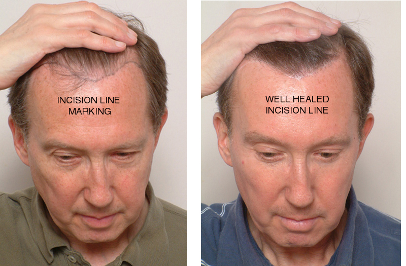 How Much Does a Hair Transplant Cost in Chandigarh?